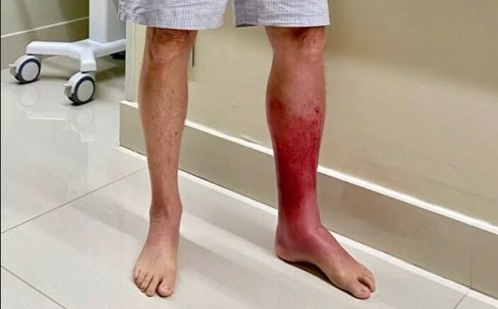 Bolsonaro mostra a perna afetada por erisipela